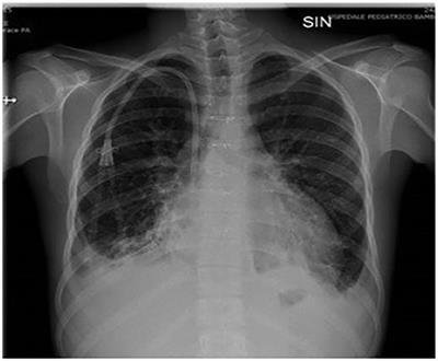 Lymphomonocytic inflammatory infiltrate with numerous eosinophilic granulocytes in the interstitium in a surviving heart transplant recipient: a case report